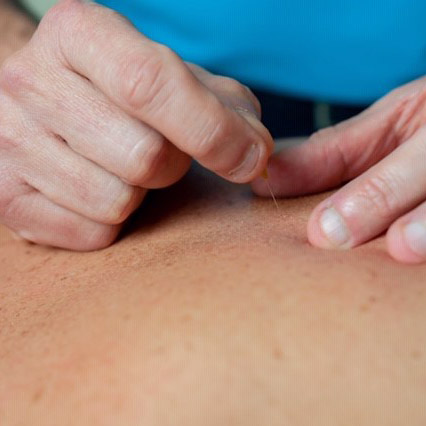 Afbeelding Dry Needling